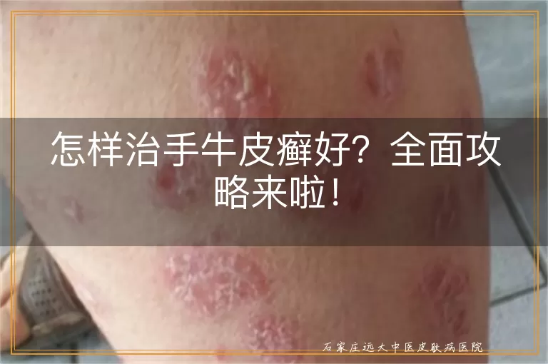 怎样治手牛皮癣好？全面攻略来啦！