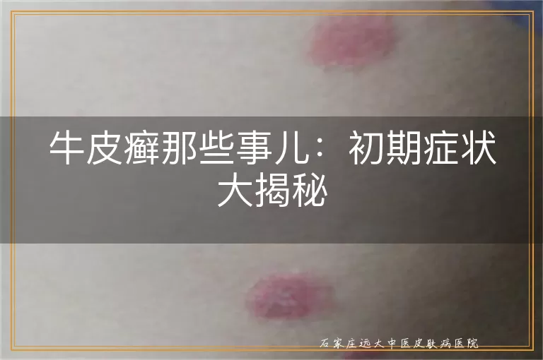 牛皮癣那些事儿：初期症状大揭秘