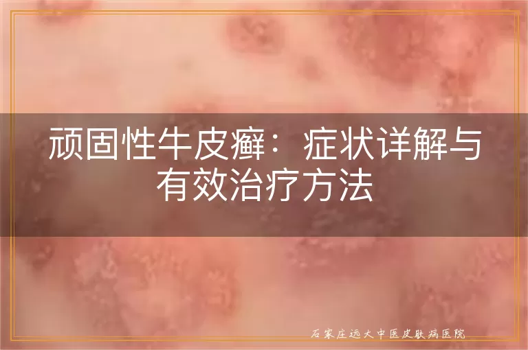 顽固性牛皮癣：症状详解与有效治疗方法