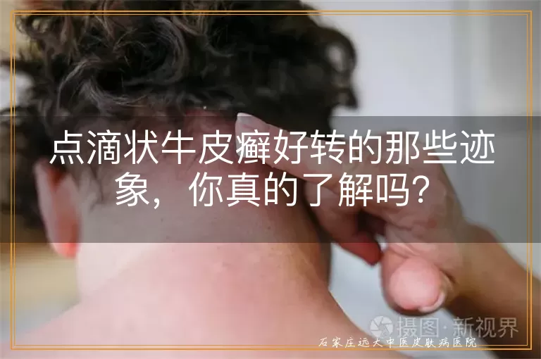 点滴状牛皮癣好转的那些迹象，你真的了解吗？