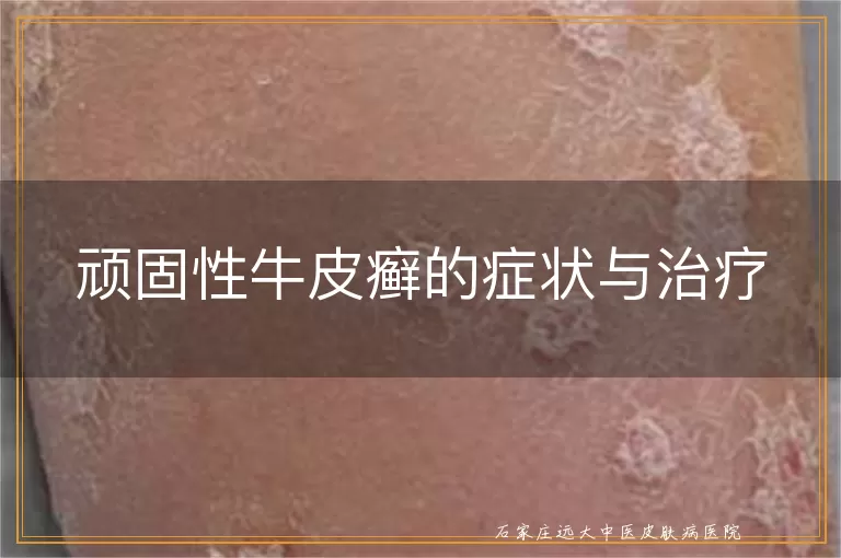 顽固性牛皮癣的症状与治疗